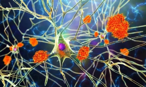 Novo tratamento para Alzheimer com Donanemabe começa a ser usado no Brasil